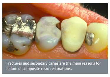thumbnail image 2 of Dental Cavity Restoration Teeth Model - Decayed Tooth For Composite Resin Practice 2 of 6