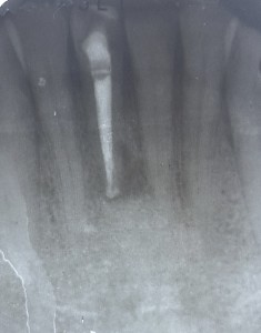 Fig 1: Completed root canal complete. Note the excessive coronal taper causing violation of the pericervical dentin.