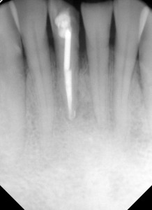 Fig 4: January 2015 - Patient complains of pain to chewing. Note that the periapical lesion has healed almost completely. However, there is a J-shaped mesial defect on 41 to the apical extent of the post.  A new 6 mm narrow periodontal pocket is detected in the area of the defect.  A vertical root fracture is suspected.  Tooth 41has a hopeless prognosis and extraction is advised.