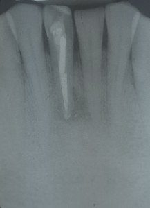 Fig 2: Placement of the post & core. Note the periapical lesion and height of the crestal bone.